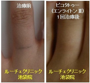 タトゥー除去ピコレーザー、1回、指、黒、とれた