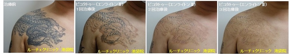 タトゥー除去ピコレーザー、3回、腕～胸、黒、経過