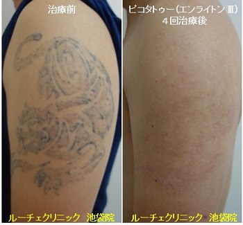 タトゥー除去ピコレーザー、4回、腕、黒、とれた