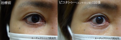 タトゥー除去ピコレーザー、アイライン下、１回、黒