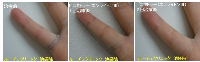 タトゥー除去ピコレーザー、2回、指、黒、とれた