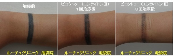 タトゥー除去ピコレーザー、3回、足、黒