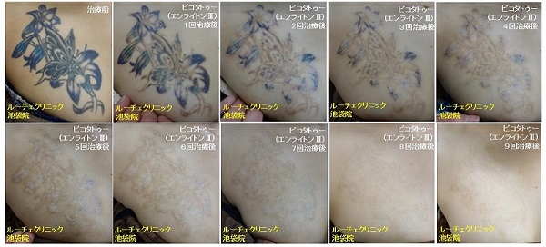 タトゥー除去ピコレーザー、9回、胸、黒、青、紫、とれた、経過