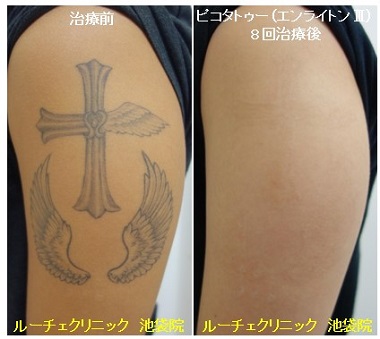 タトゥー除去ピコレーザー、8回、腕、黒、とれた