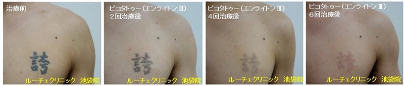 タトゥー除去ピコレーザー、6回、胸、黒