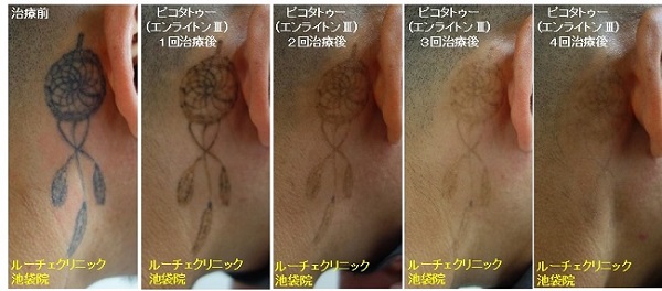 タトゥー除去ピコレーザー、4回、項、黒、経過