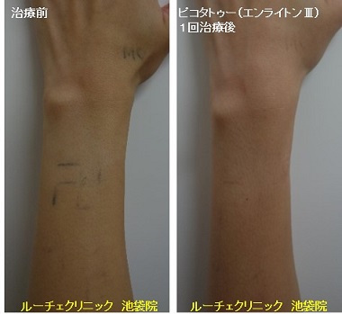 タトゥー除去ピコレーザー、1回、手首、黒