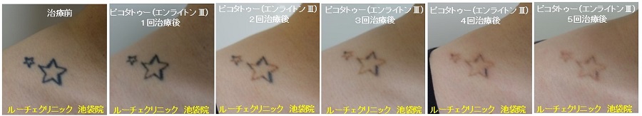 タトゥー除去ピコレーザー、5回、鎖骨、黒、経過