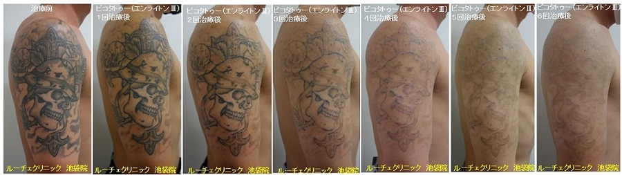 タトゥー除去ピコレーザー、6回、腕、黒、経過