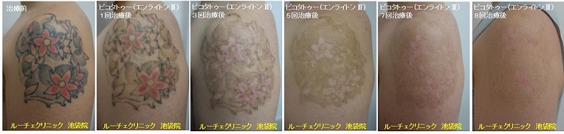 タトゥー除去ピコレーザー、８回、腕、黒、赤、黄色、緑、経過、とれた