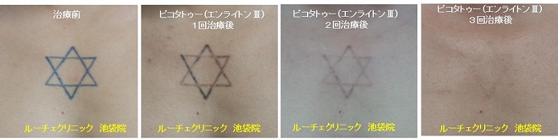 タトゥー除去ピコレーザー、3回、胸、黒、経過、とれた