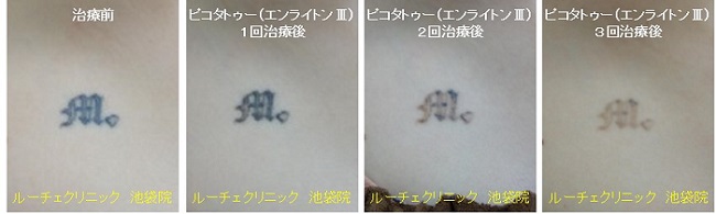 タトゥー除去ピコレーザー、3回、胸、黒