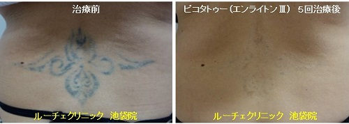 タトゥー除去ピコレーザー、5回、腰、黒、とれた