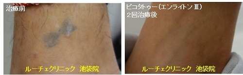 タトゥー除去ピコレーザー、2回、足首、黒、とれた