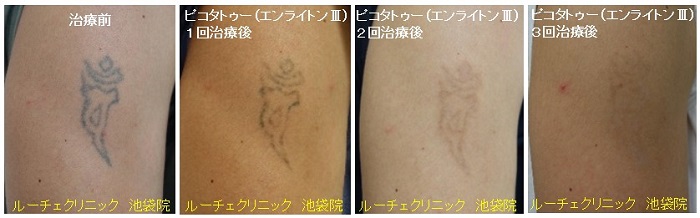 タトゥー除去ピコレーザー、3回、腕、黒、経過、とれた