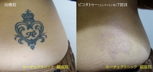 タトゥー除去ピコレーザー、7回、腰、黒、とれた