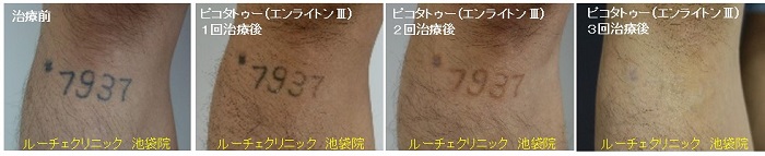 タトゥー除去ピコレーザー、3回、足、黒、経過、とれた