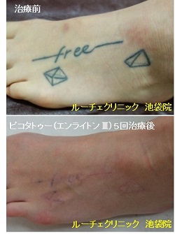 タトゥー除去ピコレーザー、5回、足、黒、とれた