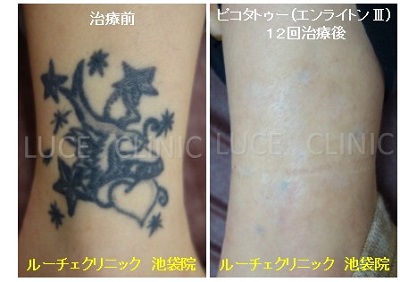 タトゥー除去ピコレーザー、12回、足、黒