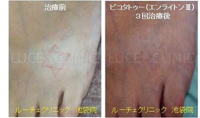 タトゥー除去ピコレーザー、3回、足、赤