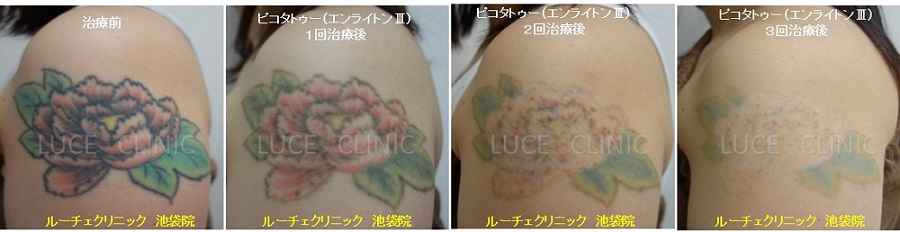 タトゥー除去ピコレーザー、3回、腕、黒、赤、緑、黄色、経過