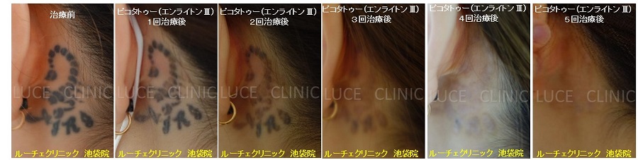 タトゥー除去ピコレーザー、5回、項、黒、経過、とれた