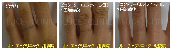 タトゥー除去ピコレーザー、２回、指、黒