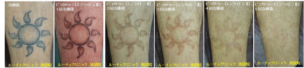 タトゥー除去ピコレーザー、5回、足、黒、経過、とれた