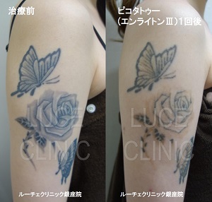 タトゥー除去ピコレーザー、１回、腕、黒