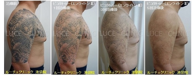 タトゥー除去ピコレーザー、5回、腕～胸、黒、経過