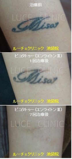 タトゥー除去ピコレーザー、7回、腕、黒、経過