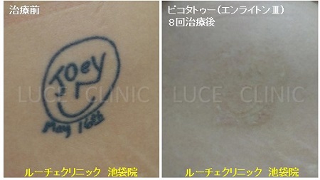 タトゥー除去ピコレーザー、8回、腰、黒