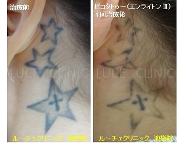 タトゥー除去ピコレーザー、1回、項、黒