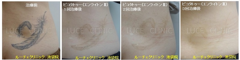 タトゥー除去ピコレーザー、3回、腰、黒、取れた、経過