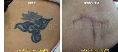 切除によるタトゥー除去