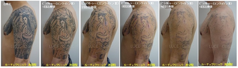 タトゥー除去ピコレーザー、５回、腕、黒、経過