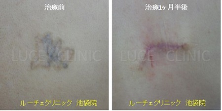 切除によるタトゥー除去