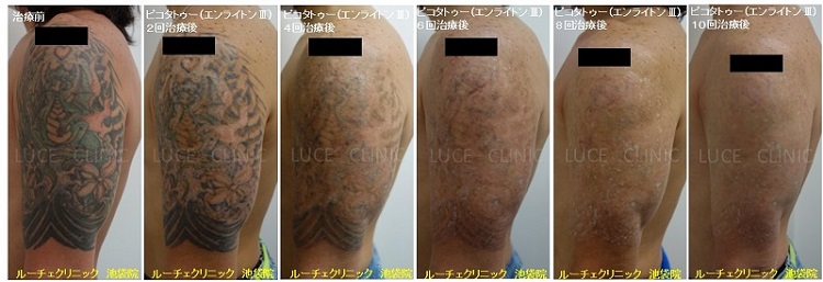 タトゥー除去ピコレーザー、10回、腕、黒、緑、赤、黄色、とれた、経過