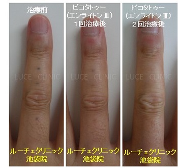 タトゥー除去ピコレーザー、2回、指、黒、とれた