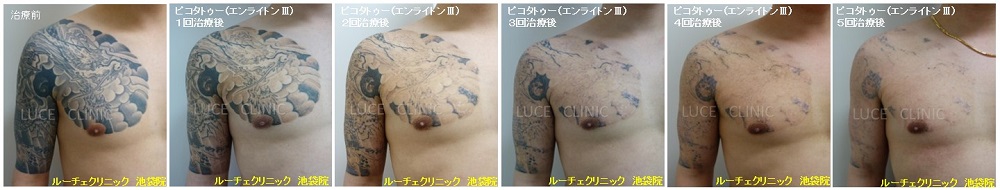 タトゥー除去ピコレーザー、5回、腕～胸、黒、経過