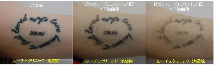 タトゥー除去ピコレーザー、4回、腕、黒