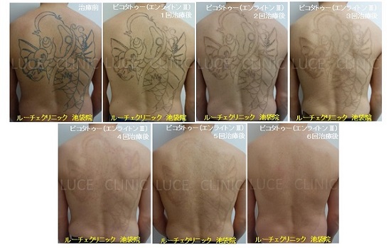 タトゥー除去ピコレーザー、6回、背中、黒