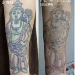 タトゥー除去ピコレーザー、３回、腕