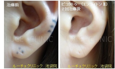 タトゥー除去ピコレーザー、2回、耳、黒、とれた