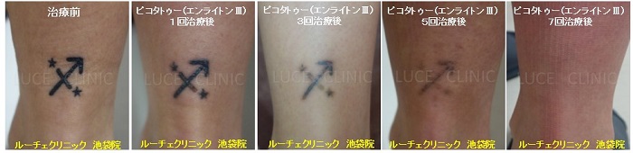 タトゥー除去ピコレーザー、7回、足、黒、経過、とれた