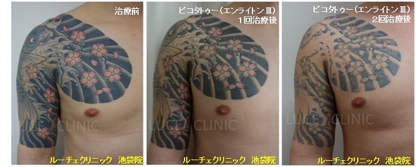 タトゥー除去ピコレーザー、2回、腕～胸、黒、ピンク、緑、黄色、経過