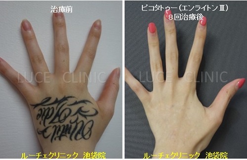 タトゥー除去ピコレーザー、8回、手、黒、とれた