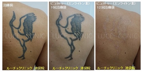 タトゥー除去ピコレーザー、12回、背中、黒