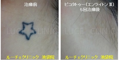 タトゥー除去ピコレーザー、5回、項、黒、とれた
