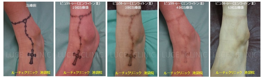 タトゥー除去ピコレーザー、5回、足、黒、経過、消えた